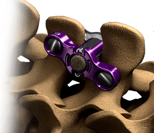 Стабилизация позвоночника ZIP ULTRA